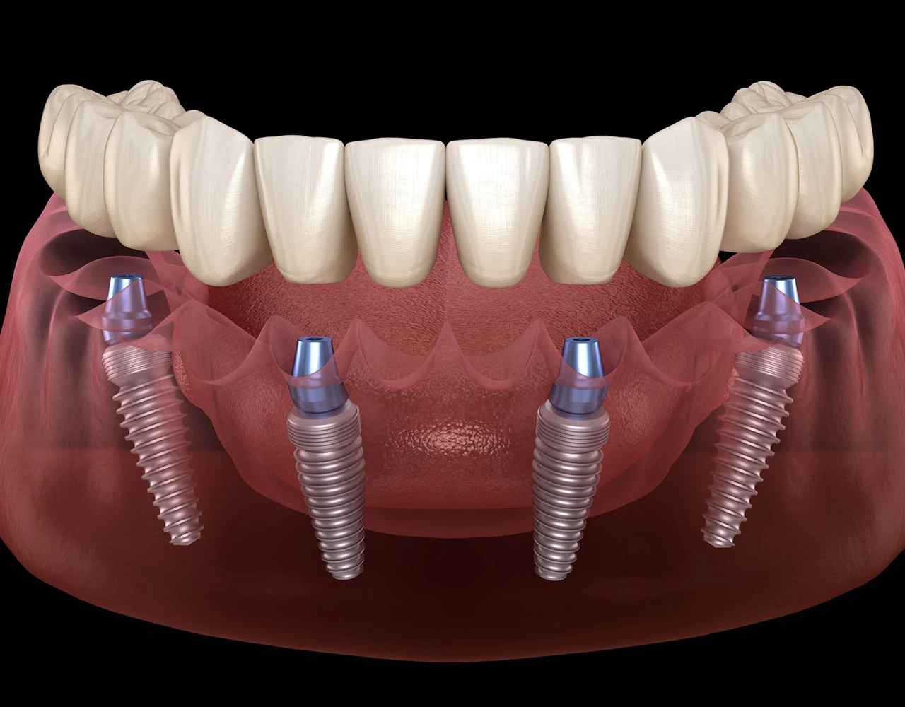 What Is Implant 2022 Güncel - Clinic Care Center