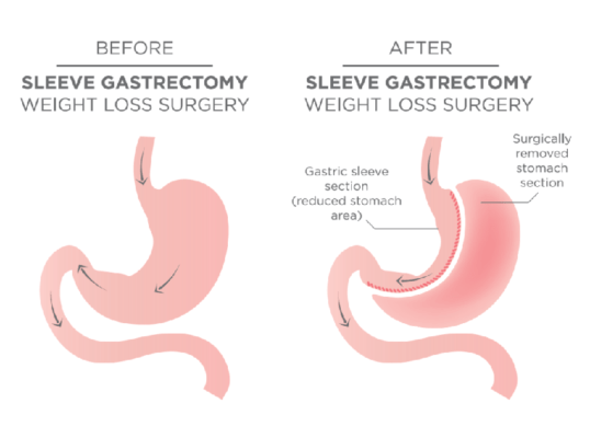 Laparoscopic Sleeve Gastrectomy Surgery