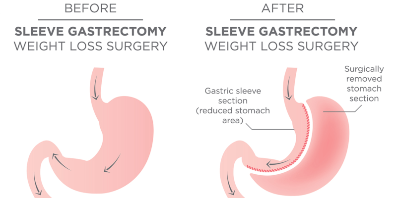 How Long Does Stomach Reduction Surgery Heal?