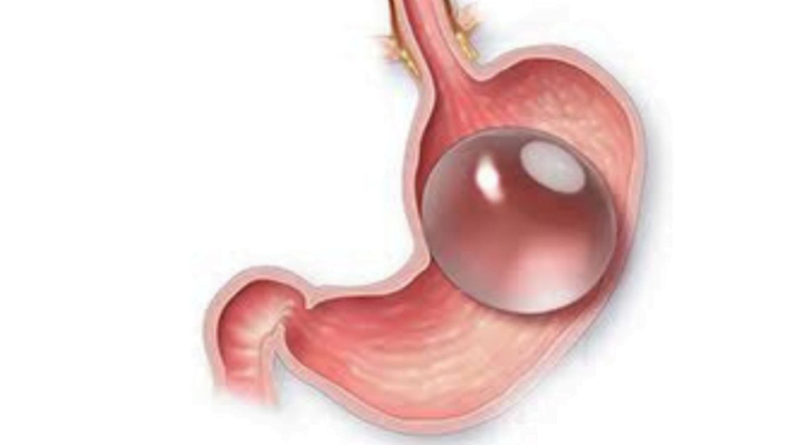 Could a Gastric Balloon Have Burst?
