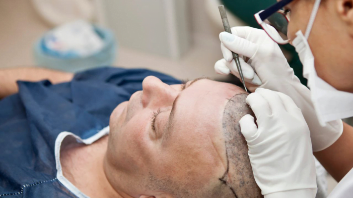Hair Transplantation with FUE Technique