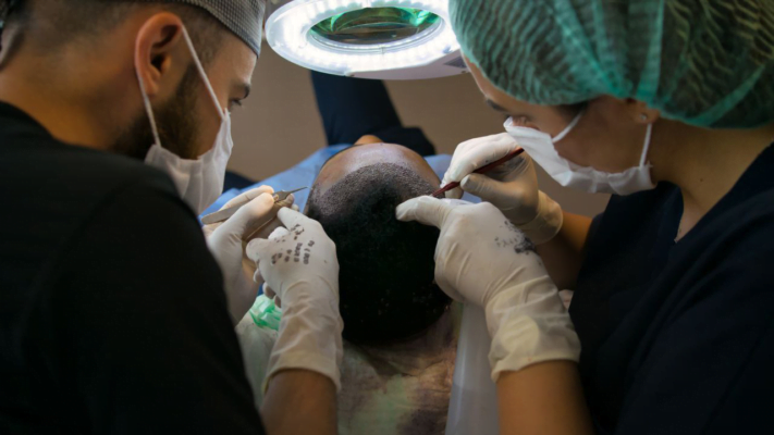 What is Fue Hair Transplantation?