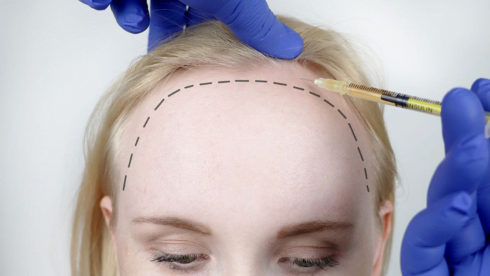Hair Transplantation with FUE Technique Price 2023 900 Usd - ClinicCare
