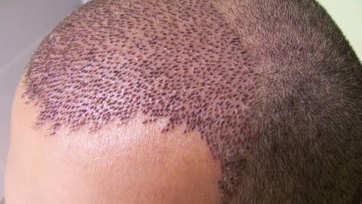 How Old Do You Have to Be for Fue Hair Transplantation?