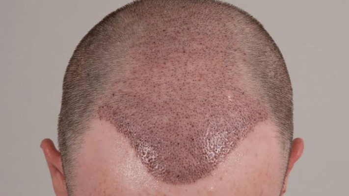 How Long is the Recovery Process of Fue Hair Transplantation?