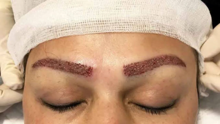 For Whom Eyebrow Transplantation Is Performed?