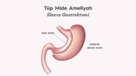 Tüp Mide Ameliyatının Avantajları ve Dezava