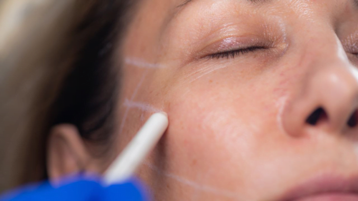 Which Way of Facial Rejuvenation is Better?