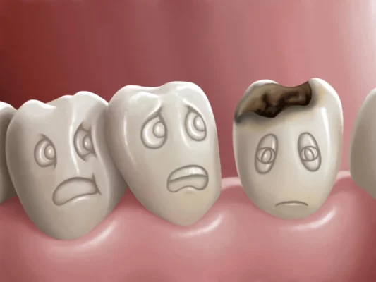 Çürük Diş Tedavisi Nasıl Yapılır, Yöntemleri