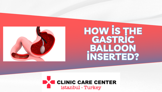 How is the gastric balloon inserted