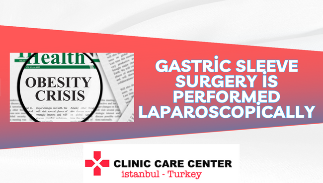 Gastric Sleeve surgery is performed laparoscopically