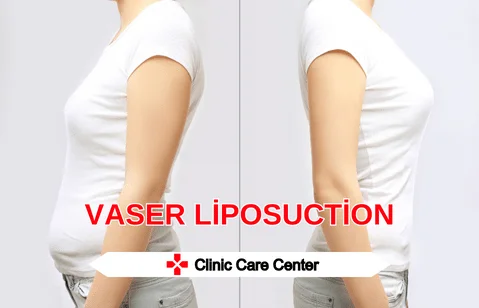 Vaser Liposuction Fiyatları 2024​