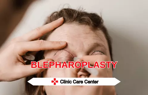 Eyelid Surgery Cost in 2024 Blepharoplasty in Turkey istanbul