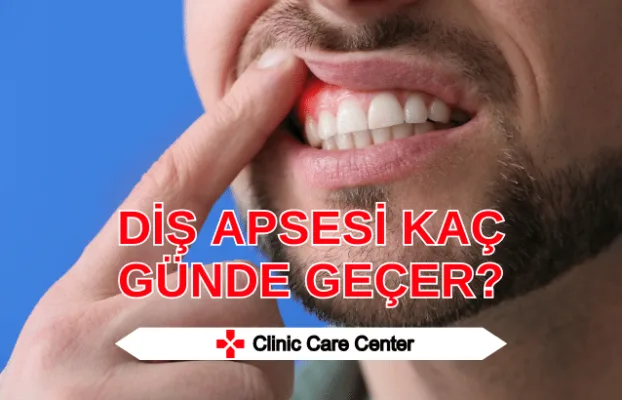 Diş Apsesi Kaç Günde Geçer