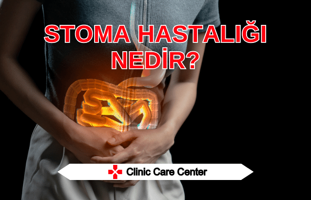 Stoma Hastalığı Nedir