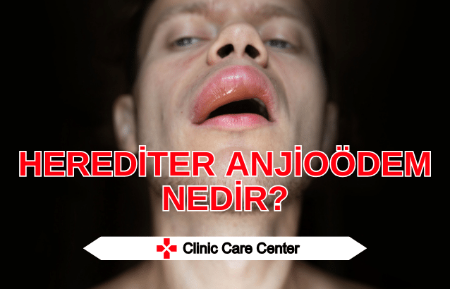 Herediter Anjioödem Nedir