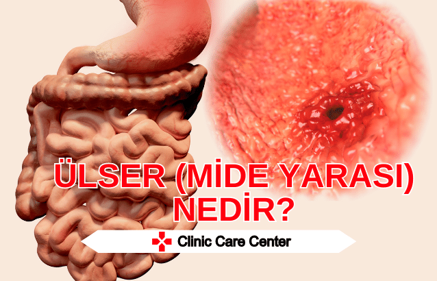 Ülser (Mide Yarası) Nedir Belirtileri ve Tedavileri