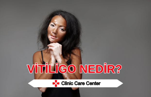 Vitiligo Nedir Kuranda Vitiligo Tedavisi