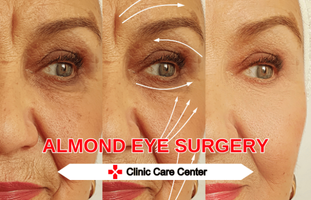 Almond Eye Surgery in Turkey