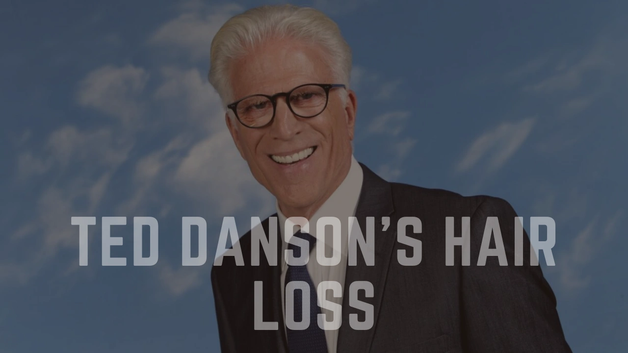 Ted Danson’s Hair Loss