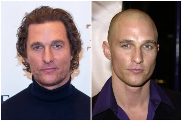 Matthew McConaughey Hair Transplant