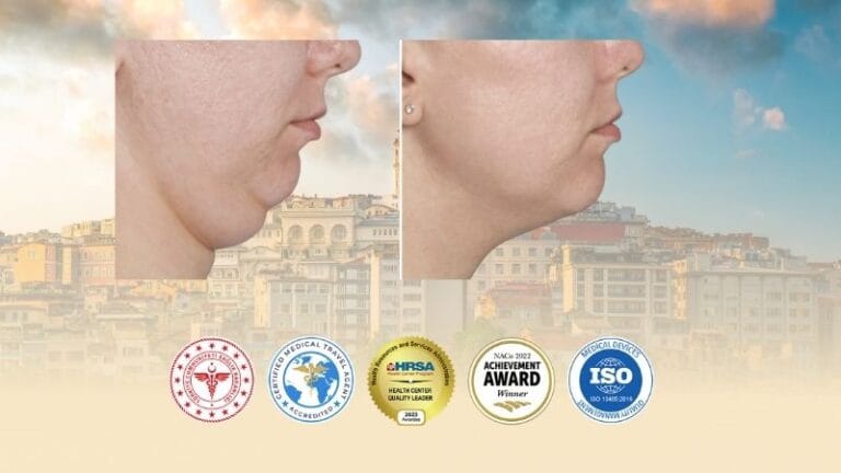Chin Liposuction Surgery in Turkey