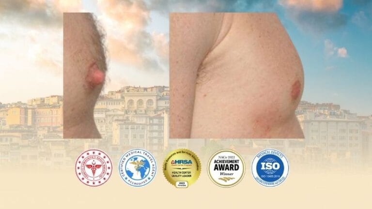 Nipple Reduction Surgery in Turkey