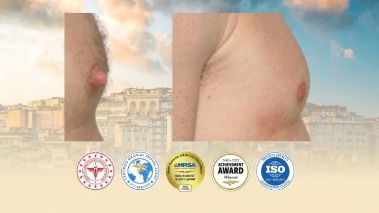 Nipple Reduction Surgery in Turkey